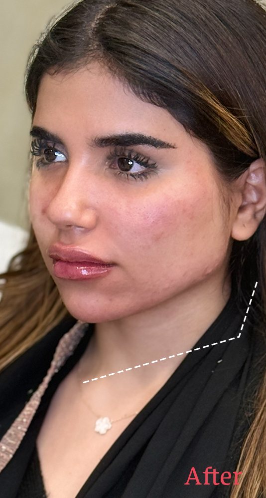 بعد — تحديد الشفاه والخدود