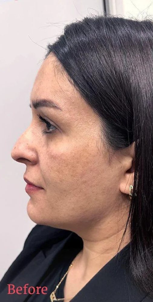 قبل — امتلاء طبيعي للخدود والوجنتين
